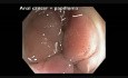 Colonoscopia: Papiloma y cáncer anal