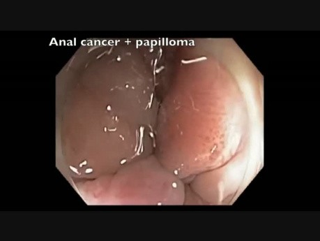 Colonoscopia: Papiloma y cáncer anal