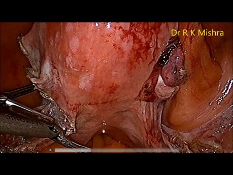 Dr R K Mishra Live Stream Lecture - transmisión en vivo - histerectomía total por vía laparoscópica