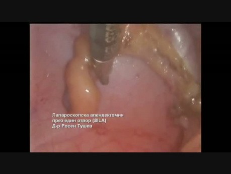 Apendicectomía laparoscópica de incisión única (SILA)
