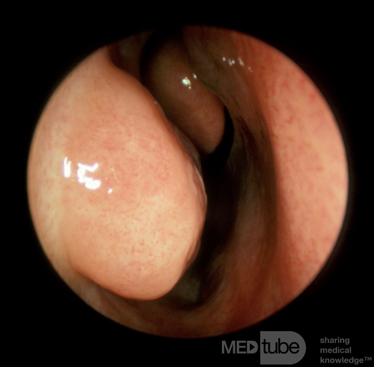 Cornete inferior vasoconstricto [izquierda]