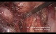 Anexectomía compleja con ureterólisis