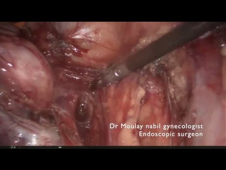 Anexectomía compleja con ureterólisis