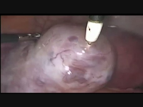 Síndrome de hiperestimulación ovárica en una mujer en preparación para la fertilización in vitro con una gangrena en el ovario derecho