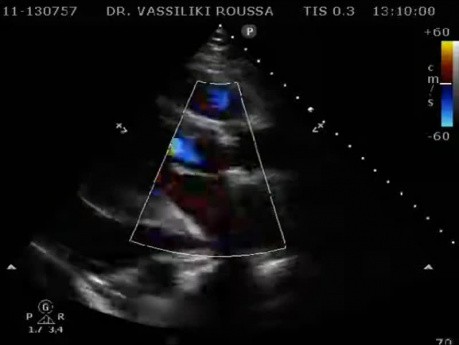 Un caso de cardiología de un derrame pericárdico postoperatorio. 