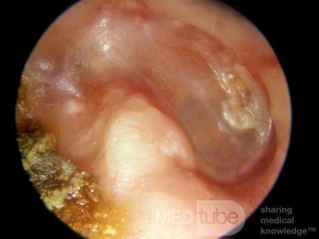 Interior de la cavidad mastoidea derecha