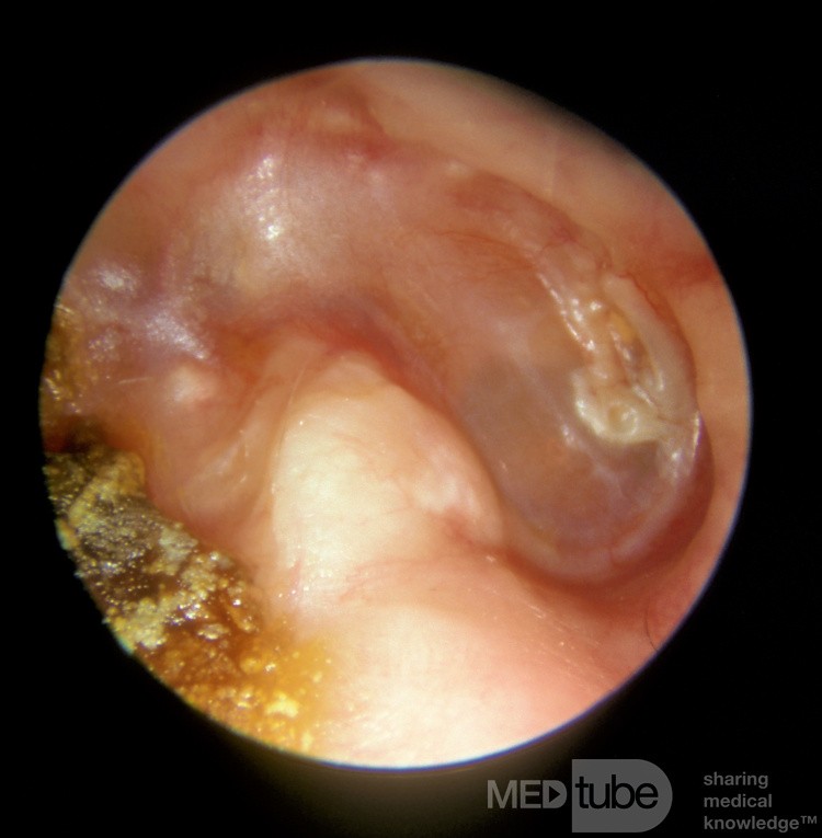 Interior de la cavidad mastoidea derecha