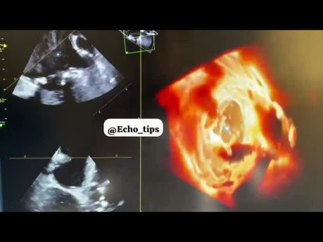 Orejuela auricular izquierda: ecocardiografía