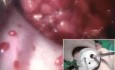 TAMIS - Resección local de tumor rectal mediante dispositivo de sitio único