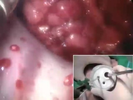 TAMIS - Resección local de tumor rectal mediante dispositivo de sitio único