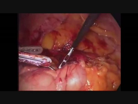 Hemicolectomía derecha laparoscópica -  acceso desde la parte superior e inferior