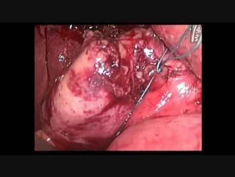 Cirugía Minilaparoscópica - II foro reducido de Port Surgery Forum