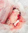 Estirpación de cavernoma subcortical 