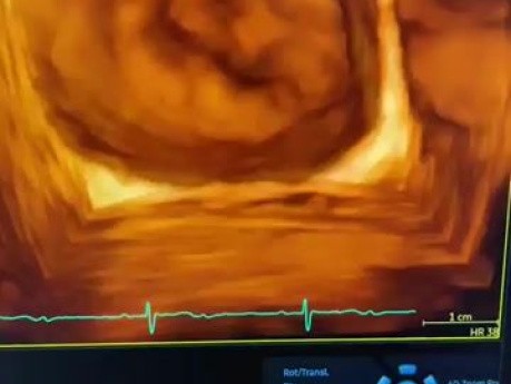 Hendidura en la valva anterior de la válvula mitral