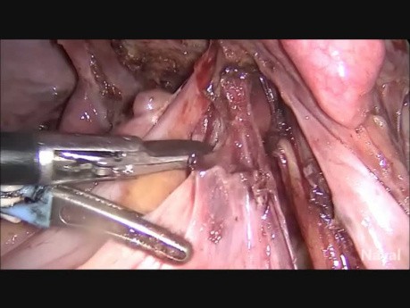 Histerectomía total laparoscópica y salpingo-ooforectomía bilateral de endometriosis en etapa 4 con escisión de endometriosis profunda