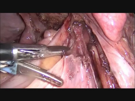 ▷ 2-fibroma-ovarico-histerectomia-ooforectomia-bilateral