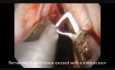 Técnica del Microflap (MLE) - Pólipo angiomatoso de cuerda vocal izquierda