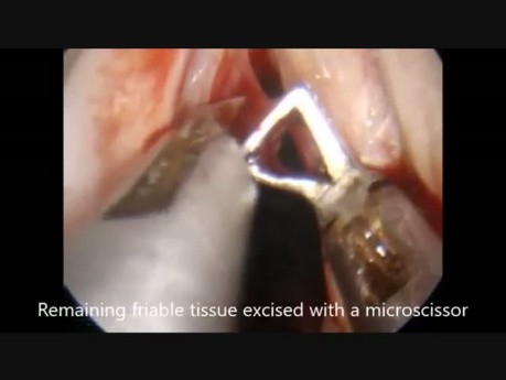 Técnica del Microflap (MLE) - Pólipo angiomatoso de cuerda vocal izquierda
