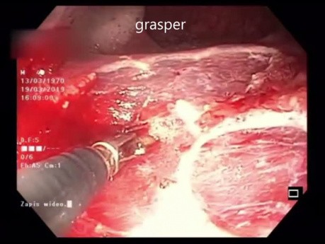 Lesión Rectal Plana LST-G en el Recto