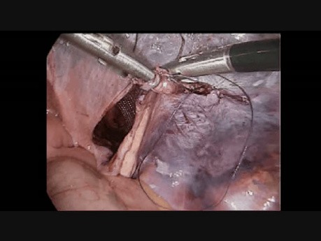 Reparación laparoscópica de hernia inguinal - paso a paso