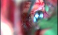 Clipaje de un aneurisma de la arteria comunicante anterior