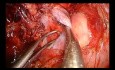 Bilobectomía intrapericárdica por VATS uniportal con resección parcial de la vena cava superior