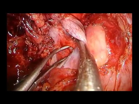 Bilobectomía intrapericárdica por VATS uniportal con resección parcial de la vena cava superior