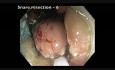 Colonoscopia - RME de una gran lesión plana en colon ascendente