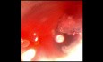 Estenosis subglotica