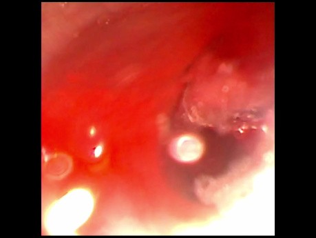 Estenosis subglotica