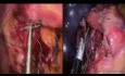 Funduplicatura Nissen LESS; utilizando tecnología revolucionaria para sutura
