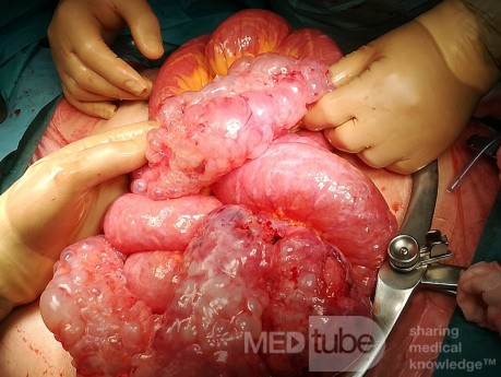 Neumatosis intestinal - oclusión y perforación en el mismo paciente