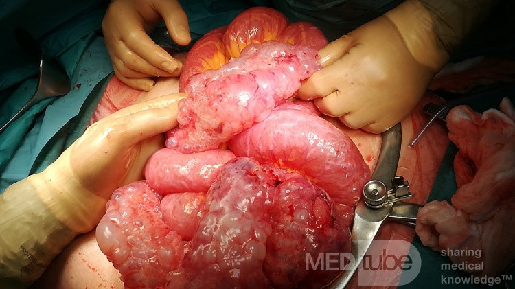Neumatosis intestinal - oclusión y perforación en el mismo paciente