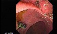 Adenocarcinoma de la vesícula biliar (1 de 3)