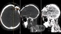 Estirpación de cavernoma subcortical 