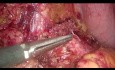 Enucleación laparoscópica del insulinoma pancreático - vídeo completo