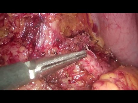 Enucleación laparoscópica del insulinoma pancreático - vídeo completo