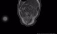Liposarcoma Retroperitoneal