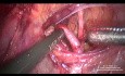 Disección anterior y ligadura de la arteria uterina en su origen  