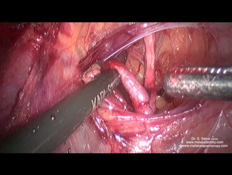 Disección anterior y ligadura de la arteria uterina en su origen  