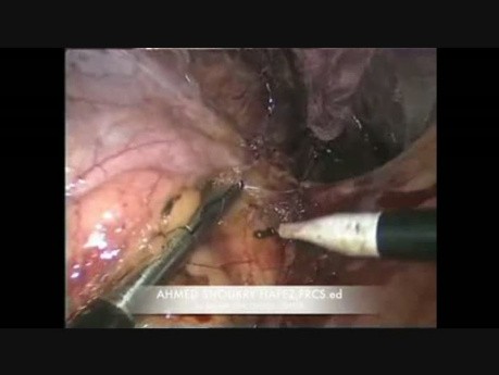 Adrenalectomía derecha laparoscópica difícil