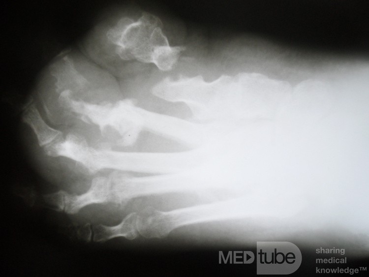 Osteomielitis