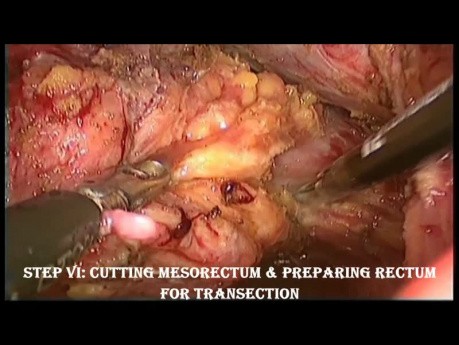 Resección anterior baja laparoscópica