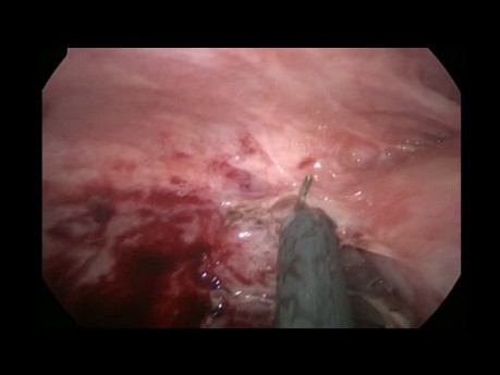 Manejo mínimamente invasivo de la apendicitis gangrenosa con peritonitis y absceso pélvico