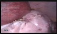 Extracción laparoscópica de un quiste ovárico grande a las 18 semanas de embarazo