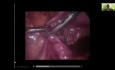 Ordeño tubárico laparoscópico para el embarazo ectópico distal