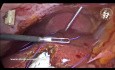 Técnicas de cierre de puertos laparoscópicos