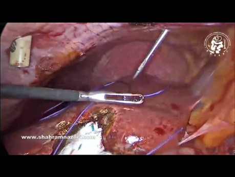 Técnicas de cierre de puertos laparoscópicos