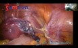 Histerectomía laparoscópica más rápida y segura