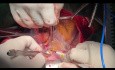Tratamiento de la endocarditis bacteriana en un paciente con transposición congénita corregida de las grandes arterias (cc-TGA)